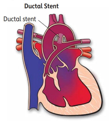 illustration of ductal stent