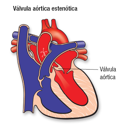 Aortic Stenosis SP