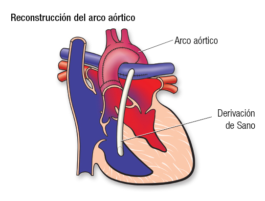 HLHS Aortic Arch SP