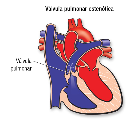 Pulmonary Stenosis SP