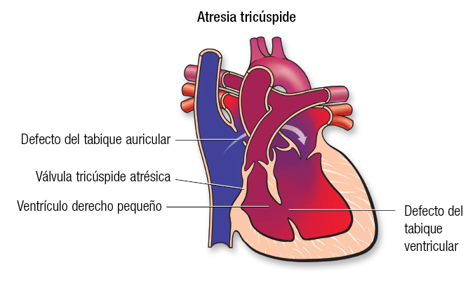 Tricuspid Atresia SP