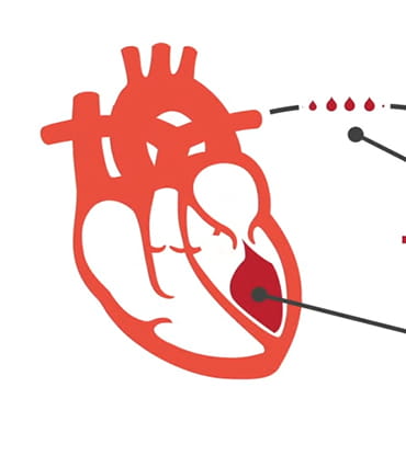 Ejection fraction video