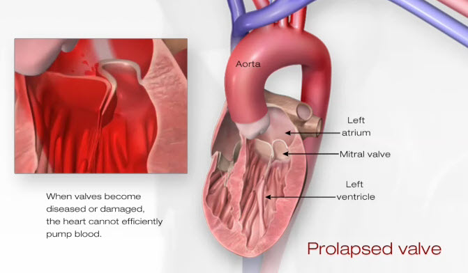 Illustration of a Prolapsed Valve