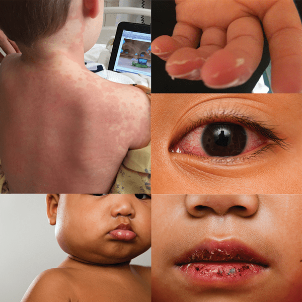 Kawasaki Disease Signs, Symptoms and Diagnosis EmPOWERED to Serve