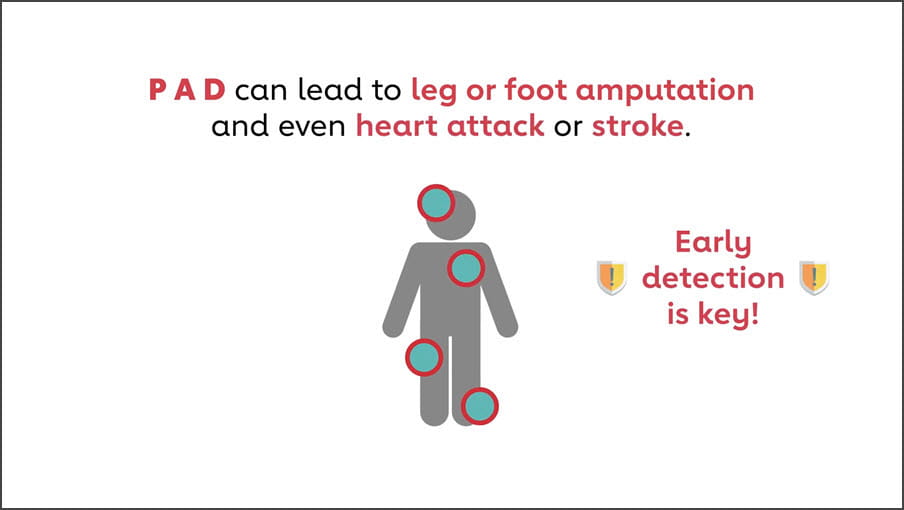 PAD can lead to leg or foot amputation, heart attack or stroke. Early detection is key.